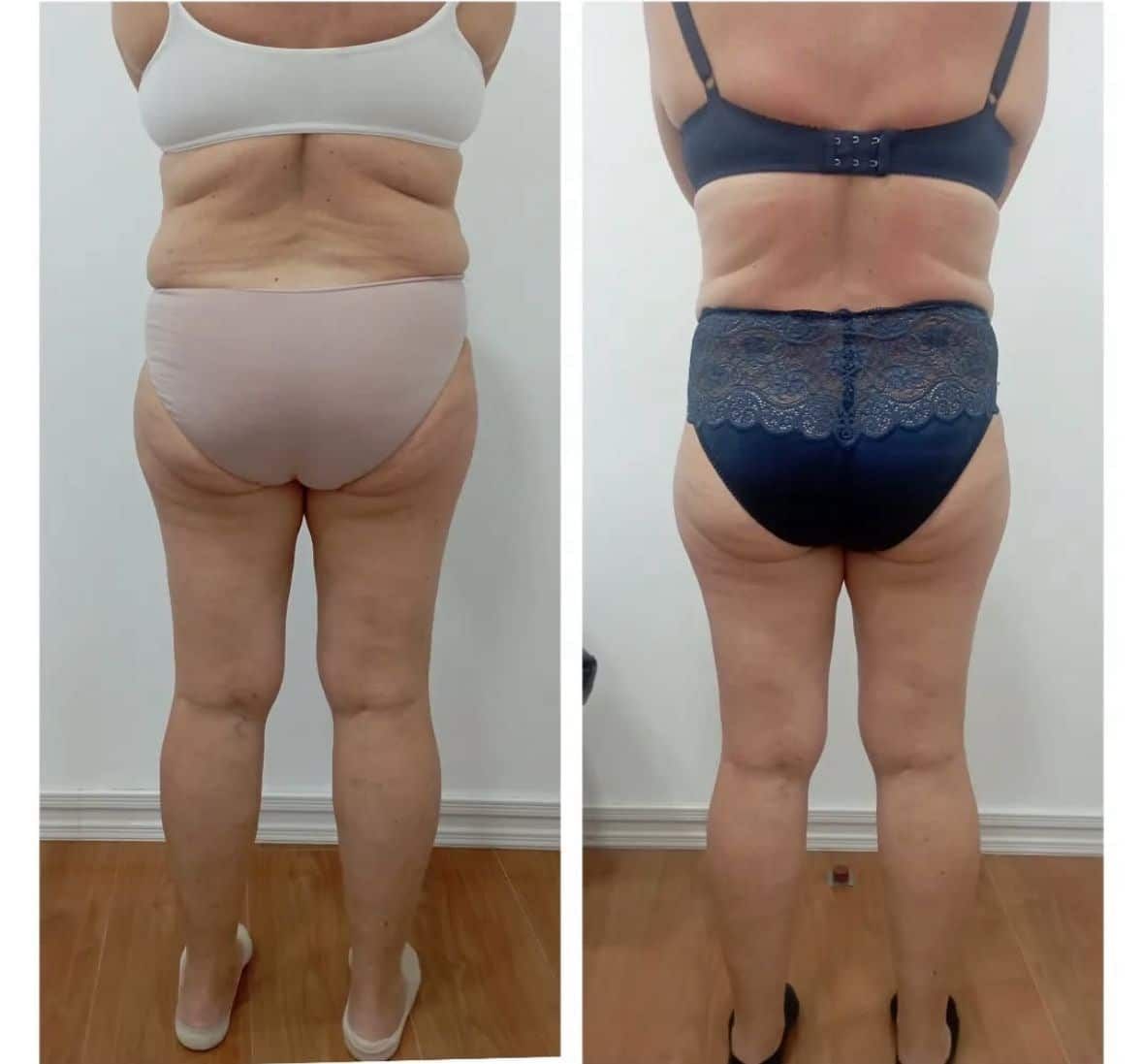 Antes / Después: Bellaction Duo corporal: silueta posterior más definida