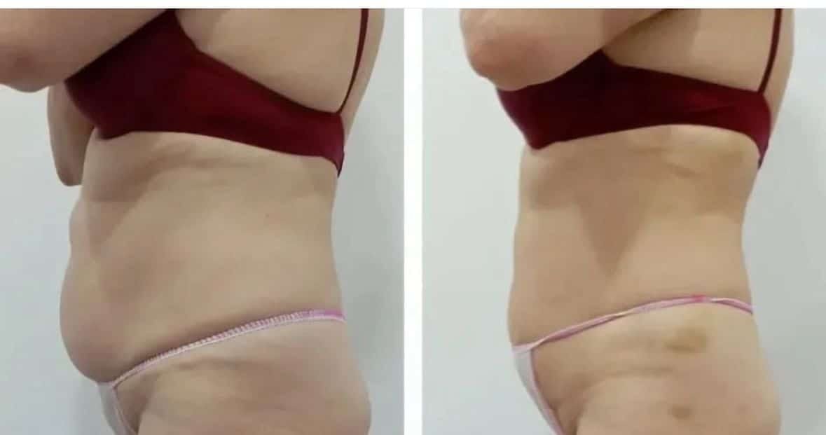 Antes / Después: Bellaction Duo corporal: abdomen y flanco con contorno más definido