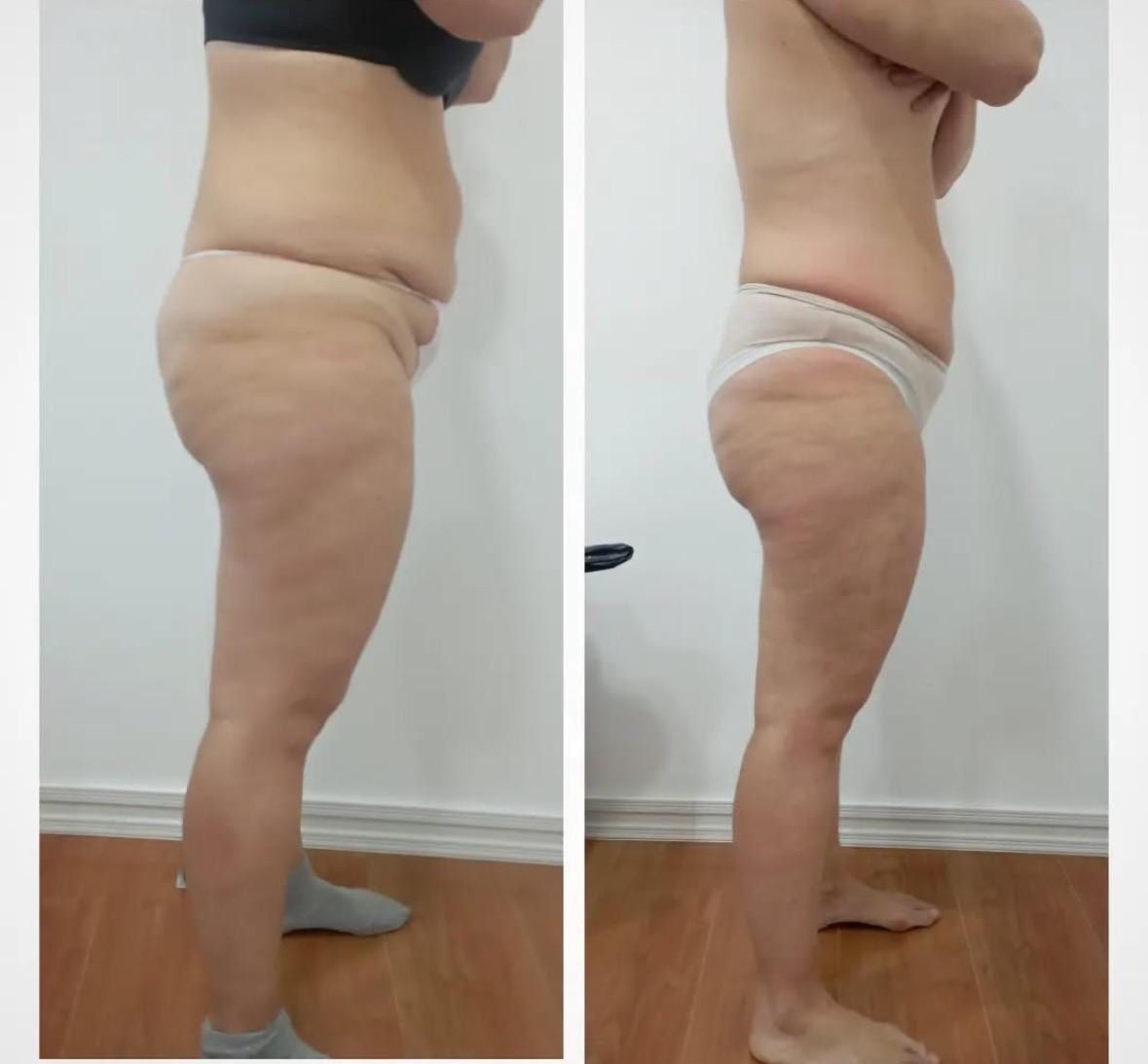 Antes / Después: Bellaction Duo corporal: perfil lateral con abdomen y glúteo más definidos