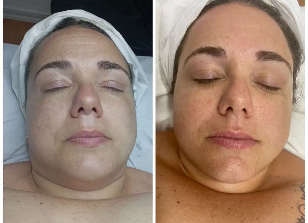 Antes / Después: Bellaction Duo facial: rostro más luminoso y definido