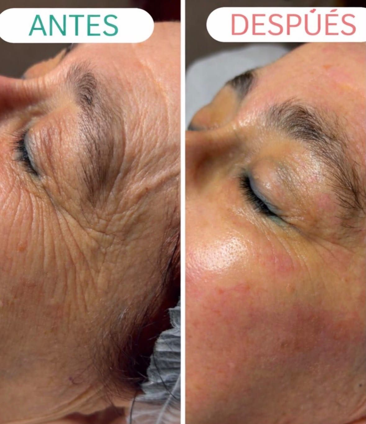 Antes / Después: Contorno de ojos: patas de gallo más suavizadas