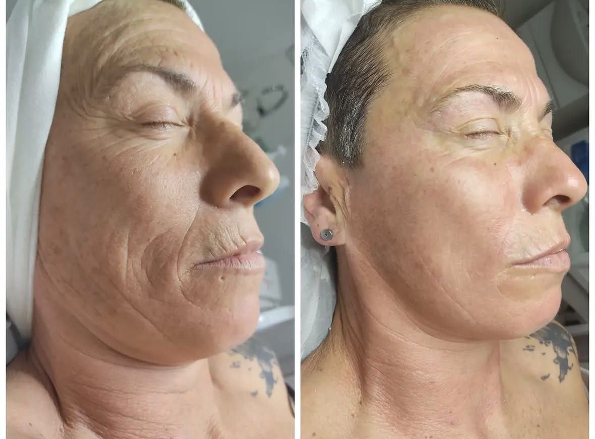Antes / Después: Dermapen: piel más uniforme y arrugas del contorno de la boca y la mejilla más suavizadas