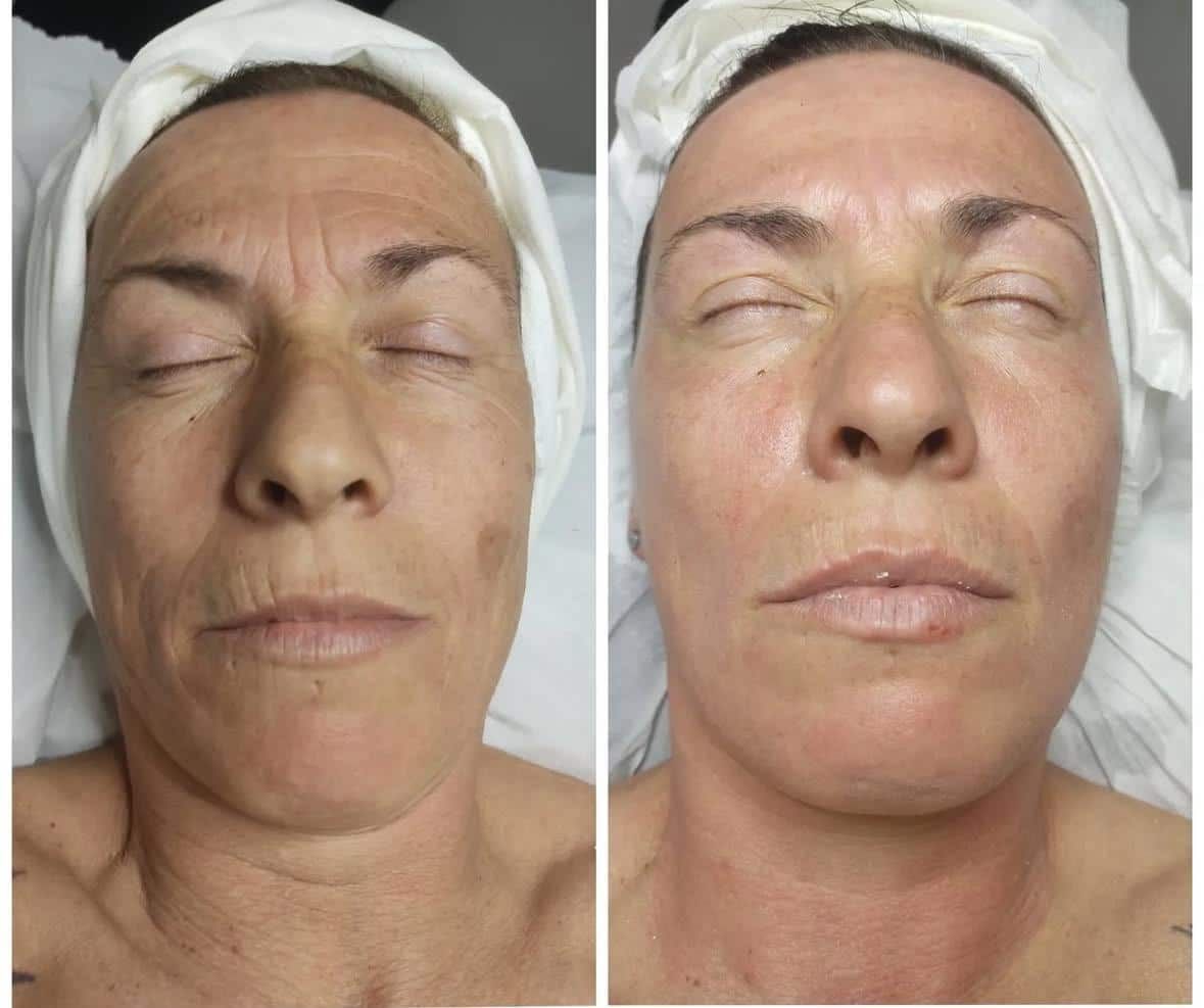 Antes / Después: Dermapen: textura y tono del rostro más homogéneos
