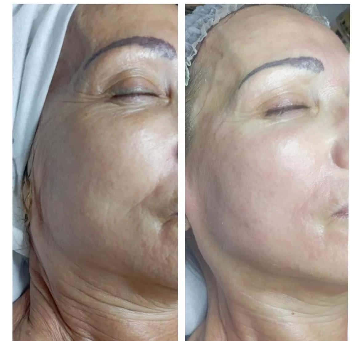 Antes / Después: Dermapen: piel más luminosa y lisa en mejilla y contorno de ojos
