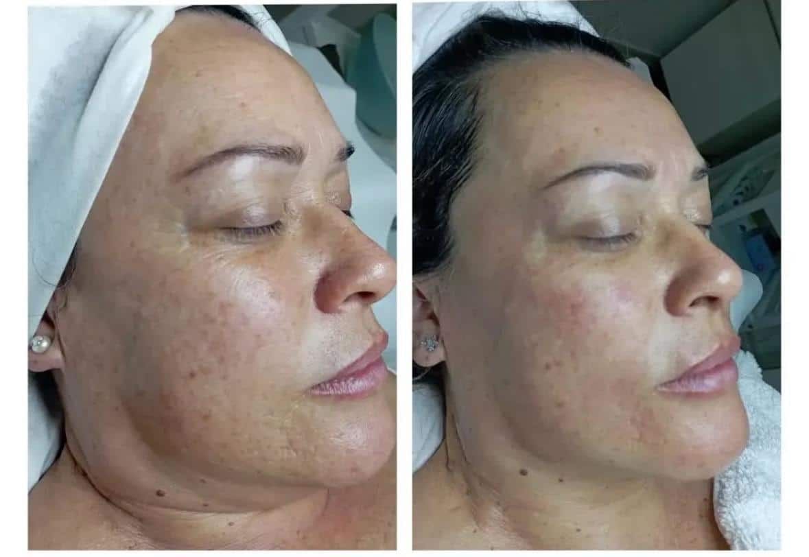 Antes / Después: Dermapen: tono más uniforme y menos manchas