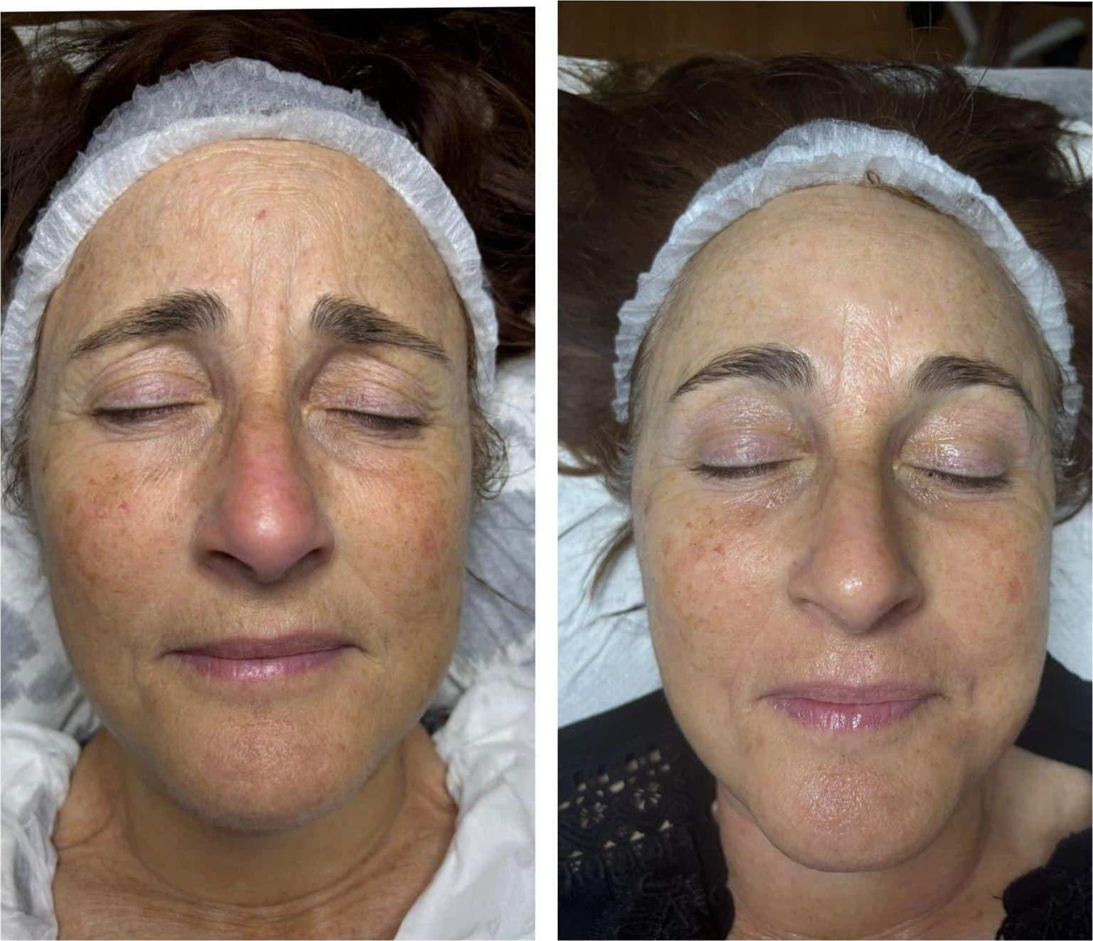 Antes / Después: Dermapen: rojeces y textura del rostro mejoradas