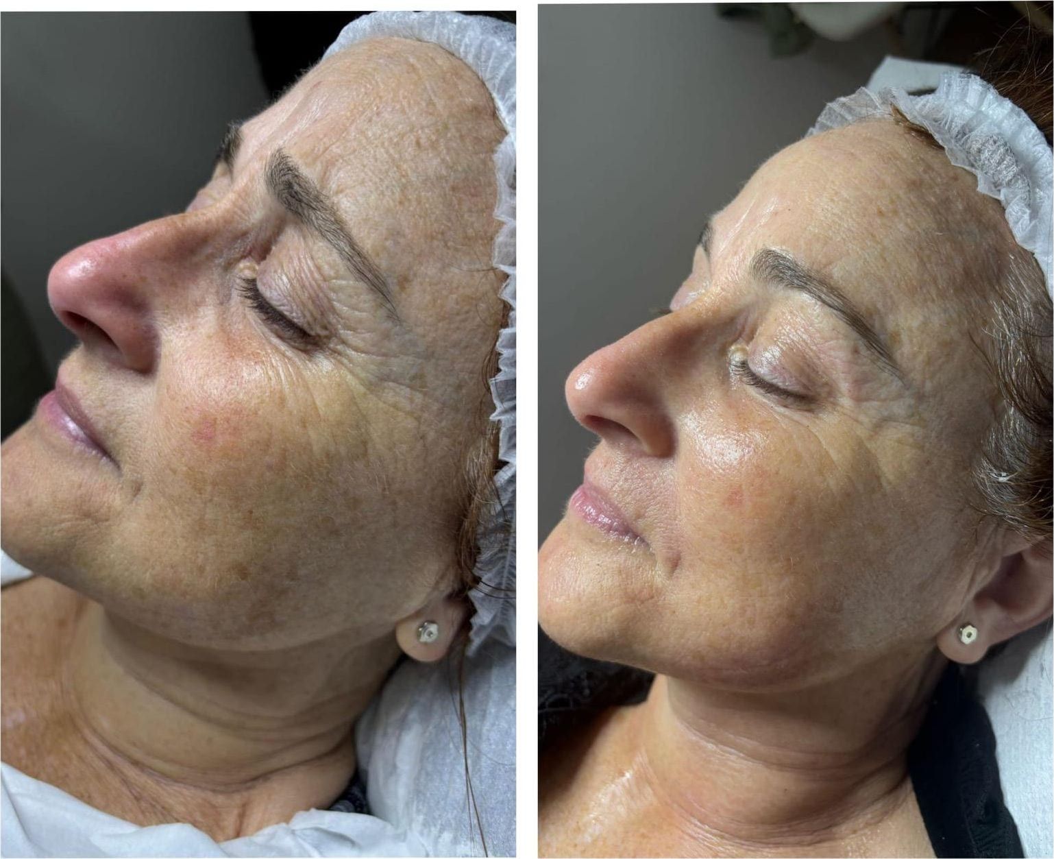 Antes / Después: Dermapen: perfil con manchas atenuadas y piel más tersa