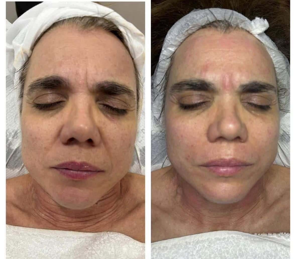 Antes / Después: Dermapen: piel más uniforme y luminosa