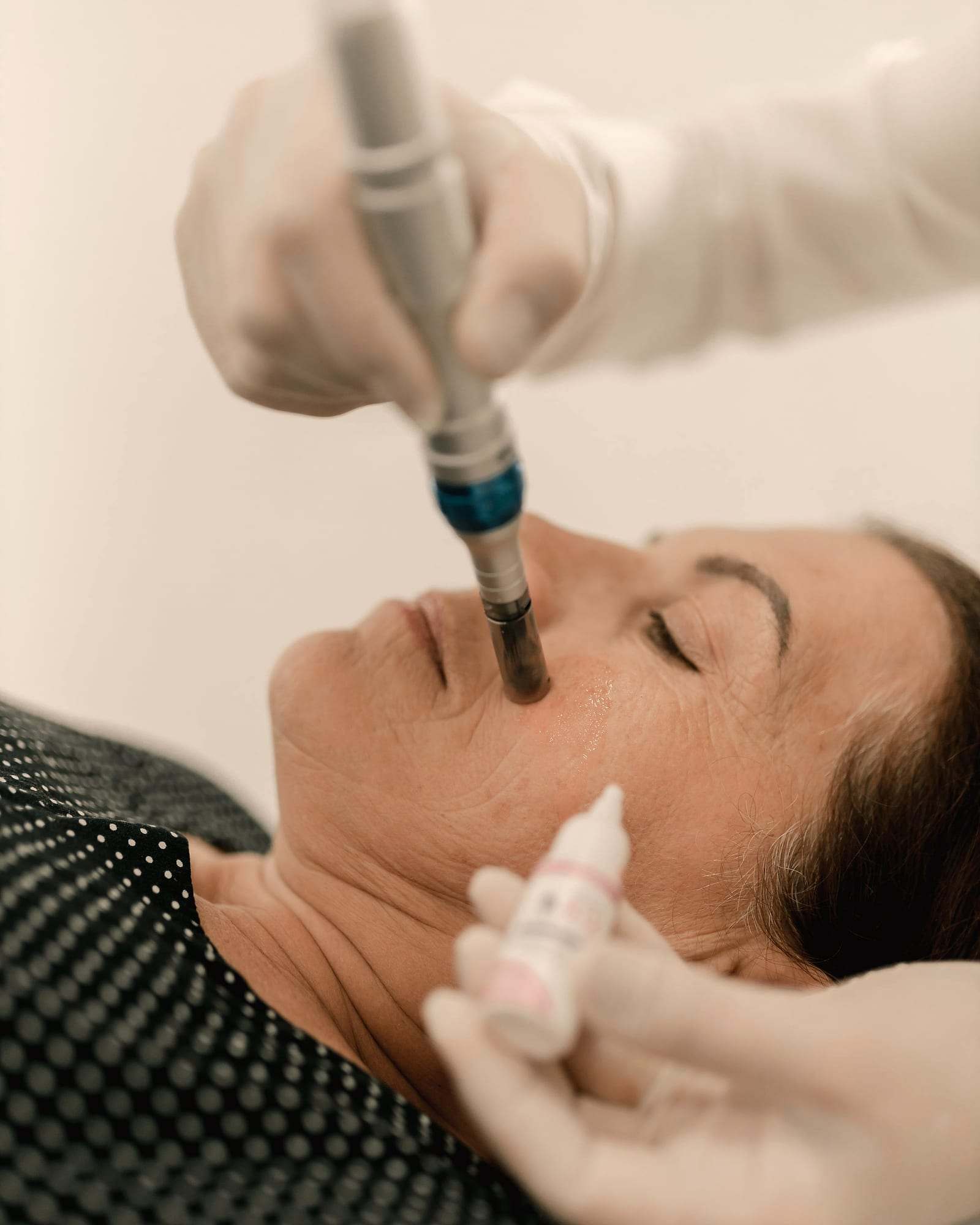 Tratamiento de microneedling con dermapen en el rostro