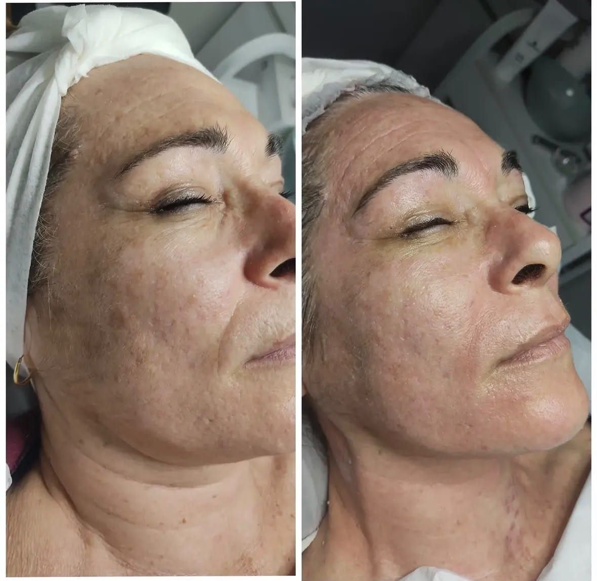 Antes / Después: Tratamiento facial: arrugas finas y textura del rostro mejoradas